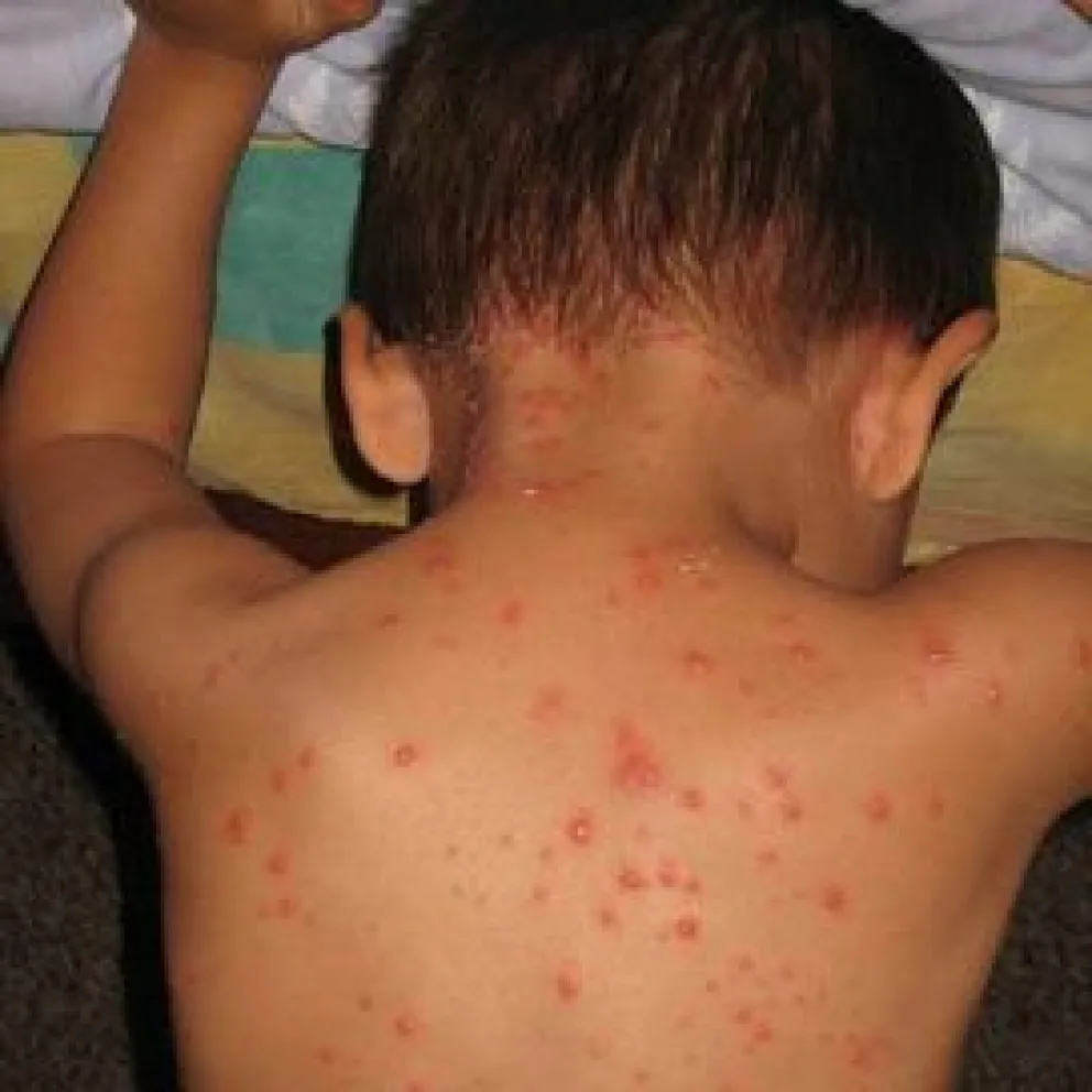 La varicela aparece con erupciones cutáneas en la piel. Foto: Ministerio de Salud