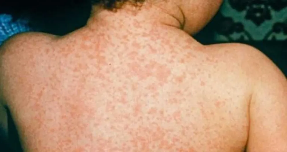 Autoridades de Salud piden a la población vacunar a los menores contra el sarampión. Foto. ABI