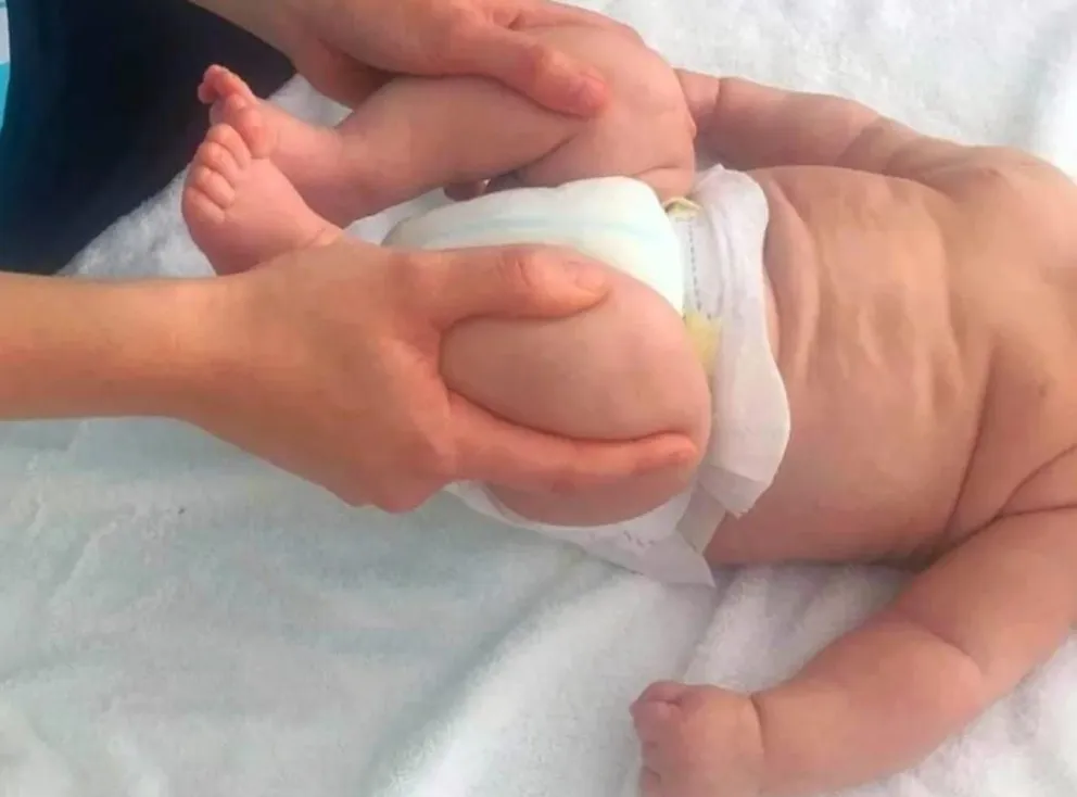 En Bolivia, tres de cada 1.000 nacidos presenta displasia de caderas.   Foto: Ministerio de Salud.