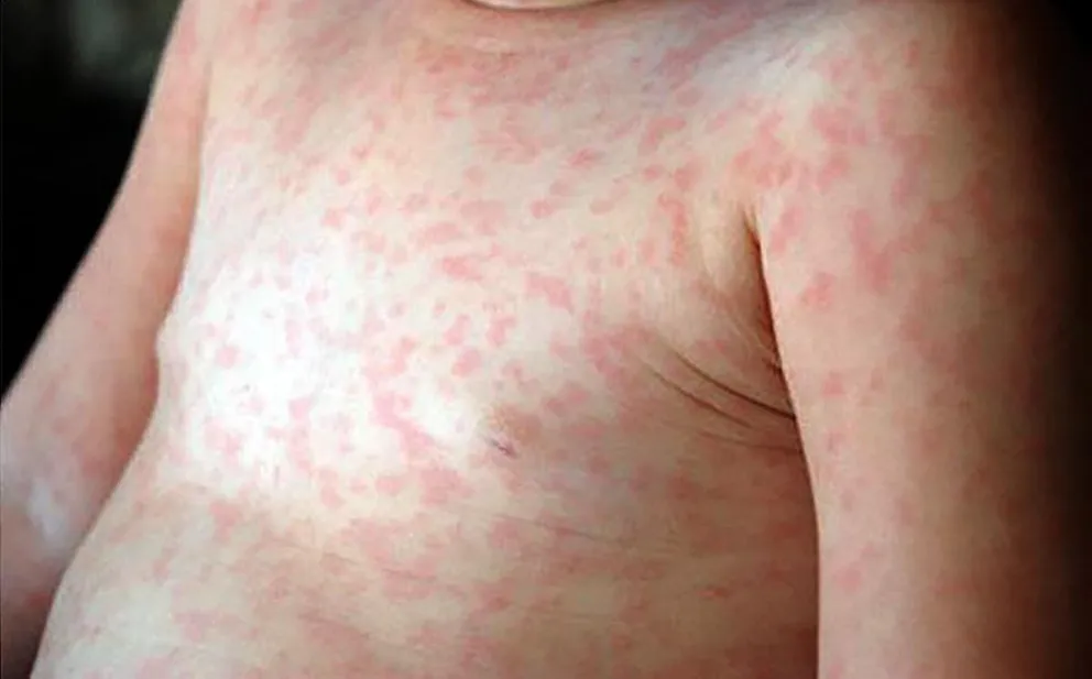 El Ministerio de Salud descartó tres casos sospechosos de Sarampión. Foto: Mini Salud.