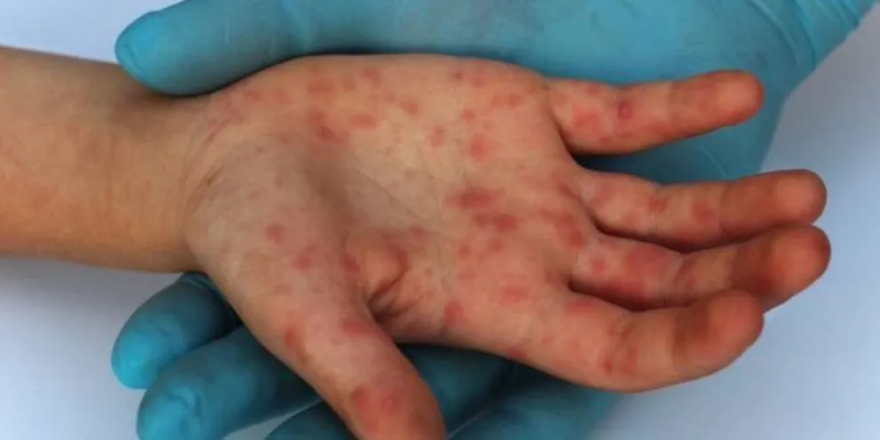 Erupciones en la piel, una característica de la viruela símica. Foto: SANA