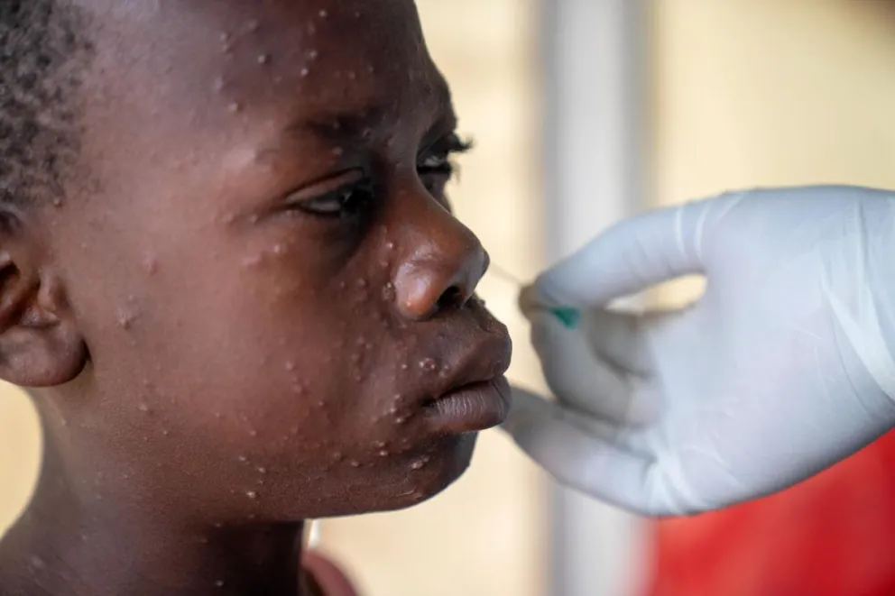 Un niño recibe tratamiento para mpox en el Congo. Foto: EFE