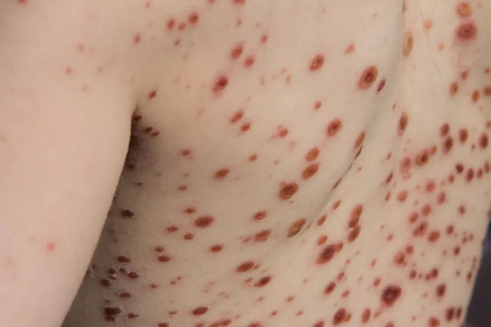 Espalda de  una persona infectada con la viruela del mono con sarpullido. FOTO: OMS