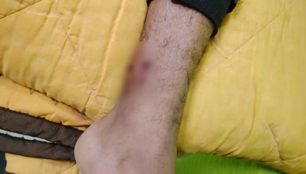 Uno de los policías que sufrió heridas en el tobillo. Foto: Policía Boliviana