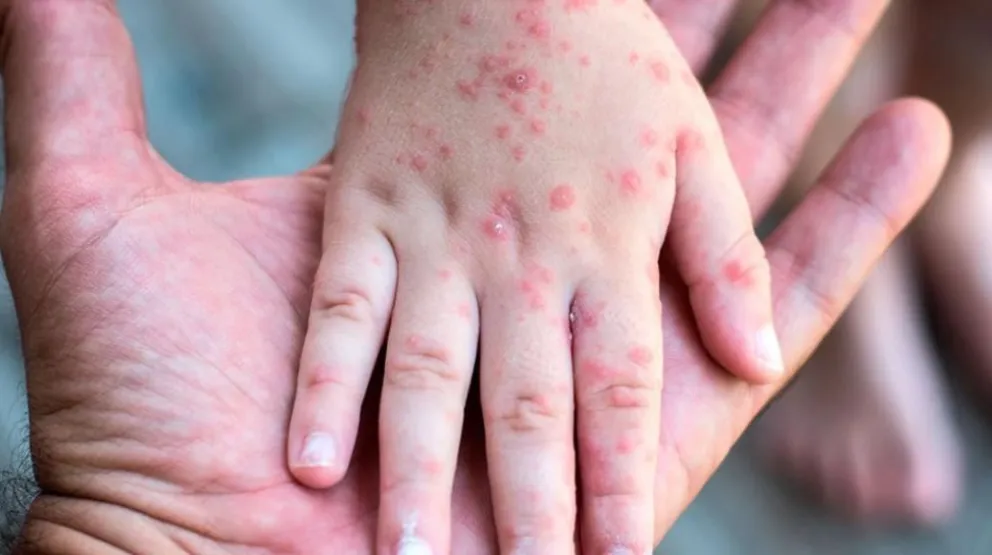 Sarpullido en la piel, uno de los síntomas del sarampión. Foto: Archivo