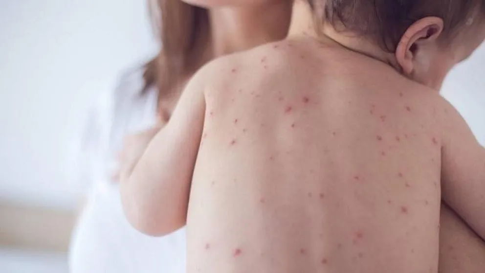 Un bebé contagiado con la enfermedad (imagen referencial). Foto: Ministerio de Salud