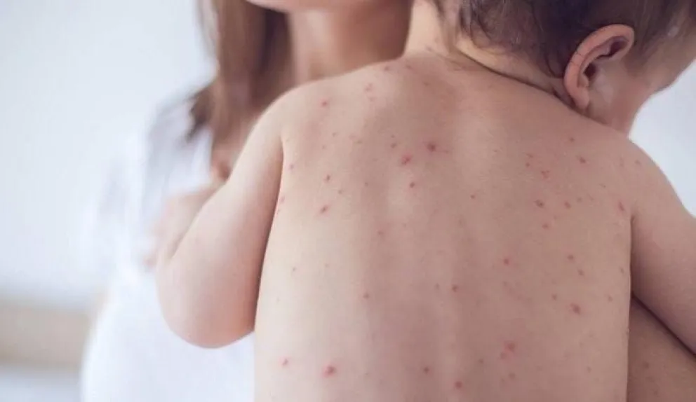 El sarampión es contagioso y autoridades insisten en la vacunación. Foto: Ministerio de Salud