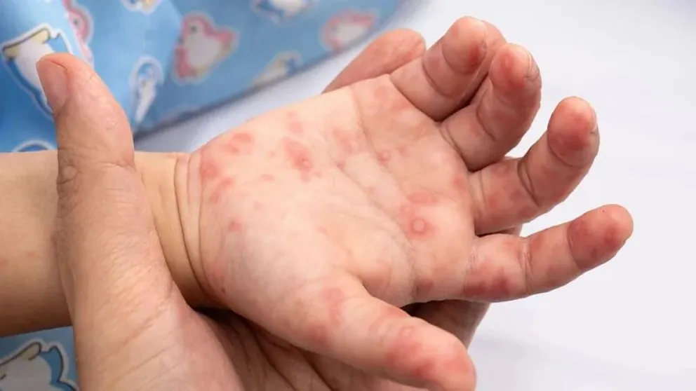 Entre los síntomas de la enfermedad figuran fiebre, dolor de garganta, malestar general y pequeñas ampollas en la boca, las palmas de las manos y las plantas de los pies. Foto: OMS